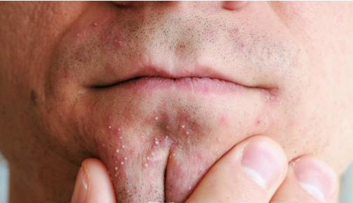 日常護膚避開去粉刺的護膚誤區 去粉刺的方法大全