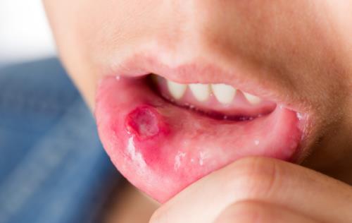 精神壓力大易導致口腔潰瘍 中醫偏方可治療口腔潰瘍