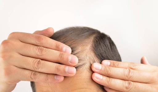 使用電腦易脫發 導致脫發的6個壞習慣