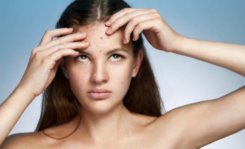 臉上反復長痘痘的6大原因