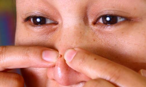 草莓鼻怎么去掉 教你幾招有效祛除黑頭