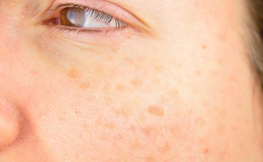 有效去除老年斑的方法小集錦