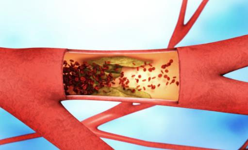 血栓是怎么形成的？如何遠離血栓？