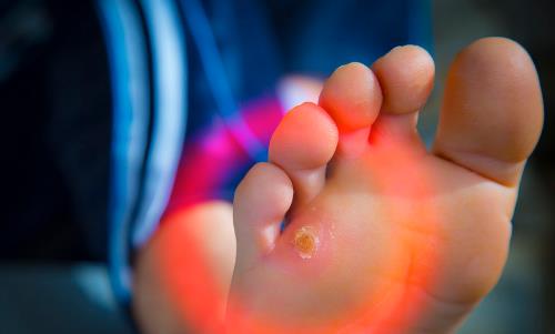 腳下出現老繭比較嚴重怎