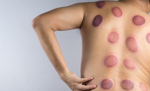 拔火罐能減肥?顏色深代表毒素多、濕氣重?