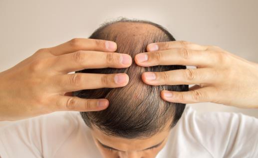 改善脫發是場持久戰 解決長期脫發問題有妙招
