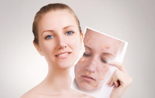 辣椒無辜背鍋!營養(yǎng)學(xué)專家說,長痘的“真兇”是這三種食