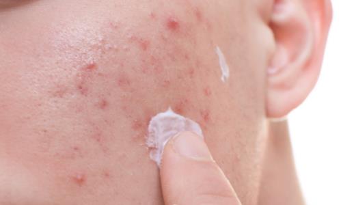 痘痘可以擠嗎 為什么會(huì)長痘痘