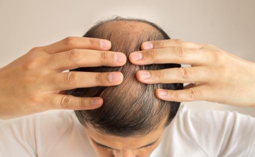 頭發少要怎么保養？四個問題要注意