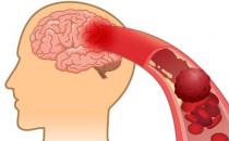 防中風控制好六大因素 生活中對中風病的日常誤區