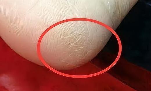 手腳脫皮的原因 八種方法預防腳脫皮