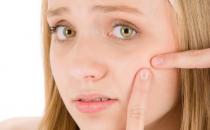 易生痘痘的人 去除痤瘡產生的印記小妙招