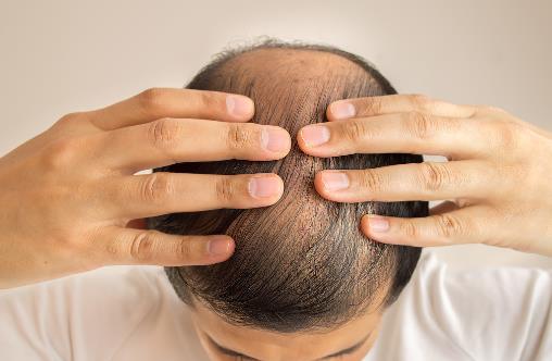 脫發(fā)厲害是身體出了問題 怎樣才能長出濃密秀發(fā)