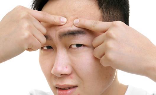 肌膚長痘痘 祛痘10大誤區應避免