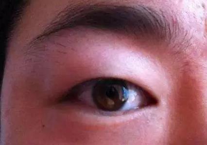 八大處整形楊欣：腫泡眼做雙眼皮手術應該注意什么？