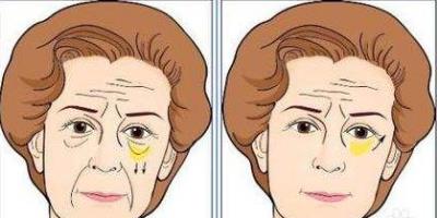 北京彤美整形醫院劉風卓眼整形怎么樣