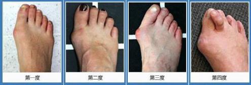 北京京醫中醫醫院治療拇外翻效果好嗎 治療安全有效有保障