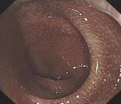 武漢漢西博仕肛腸醫院：長期喝清腸茶 警惕結腸黑變病