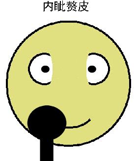 內眥贅皮怎么做效果好——北京彤美整形醫院劉風卓