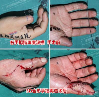 濟南顯微外科醫(yī)院 黃威手指再造怎么樣 有真實的手術(shù)案例嗎