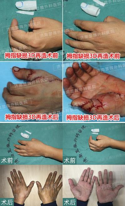 濟南顯微外科醫(yī)院 黃威手指再造怎么樣 有真實的手術(shù)案例嗎