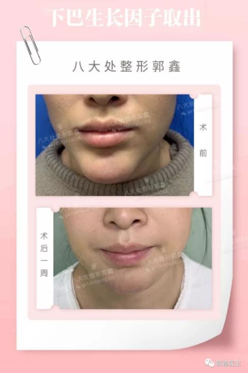 八大處整形郭鑫教授:下巴注射物取出需要多久