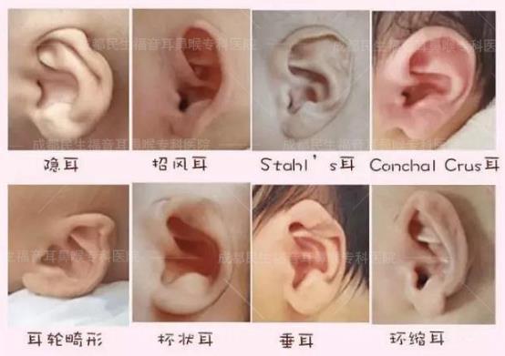 新生兒耳廓畸形能矯正嗎？看成都民生耳鼻喉醫院如何支招
