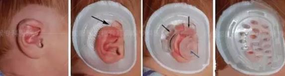 新生兒耳廓畸形能矯正嗎？看成都民生耳鼻喉醫院如何支招