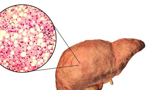 脂肪肝患者飲食禁忌有哪些 預防脂肪肝的食物要多吃