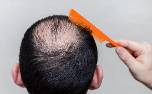 當代壓力大脫發的人越來越多 冬日防禿的日常妙招