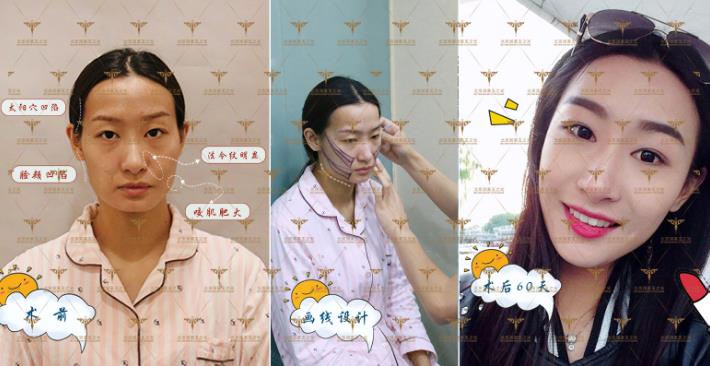 自體多肽脂肪實現新突破，塑造無法復制的自然美