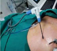 深圳腫瘤醫院請選擇廣州復大腫瘤醫院：微波消融保肝抗癌