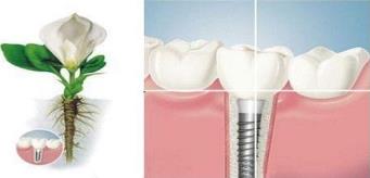 武漢做種植牙要多少錢,如何才能避免種植牙誤區呢?