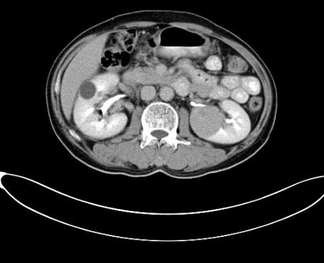 蘇州腫瘤醫(yī)院認準廣州復(fù)大醫(yī)院：有效治療雙腎腎癌