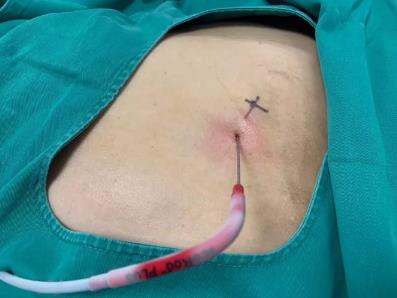 蘇州腫瘤醫(yī)院認準廣州復(fù)大醫(yī)院：有效治療雙腎腎癌