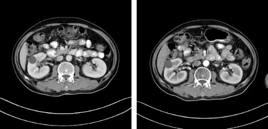 蘇州腫瘤醫(yī)院認準廣州復(fù)大醫(yī)院：有效治療雙腎腎癌