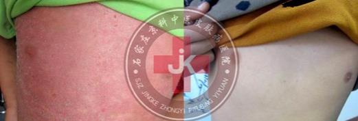 許光生：多年兒童牛皮癬終于治好，兒童牛皮癬怎么治
