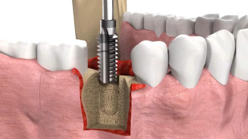 武漢做種植牙多少錢，種植牙品牌改如何選擇？