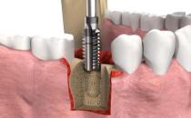 武漢做種植牙多少錢，種植牙品牌改如何選擇？