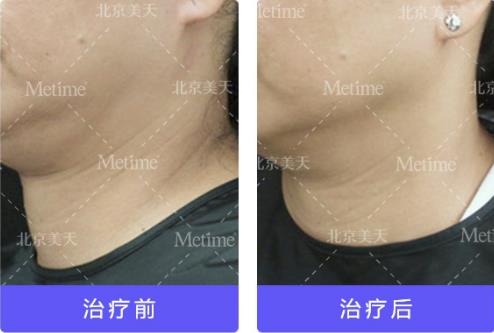 熱瑪吉抗衰(Thermage)官方認證中國指定操作醫生—北京美天張潘院長