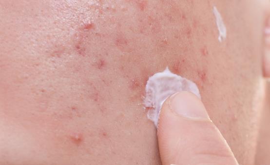 秋冬季節去除閉口粉刺有妙招 去除粉刺的食療方推薦