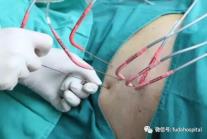 廣州復大腫瘤醫院牛立志:晚期肺癌引起失眠如何治療