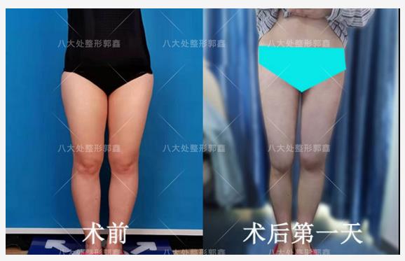 八大處整形郭鑫教授解答：大腿吸脂手術瘦腿明顯嗎