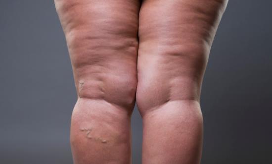 總是吃太咸的食物易引發(fā)水腫 吃得太咸還會引發(fā)什么疾病