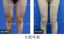 八大處整形郭鑫教授解答：大腿吸脂手術瘦腿明顯嗎