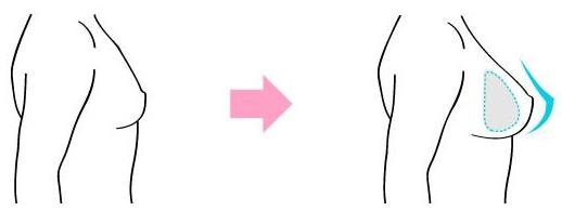 原來假體隆胸還可以這樣解釋!