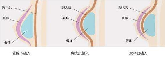 原來假體隆胸還可以這樣解釋!