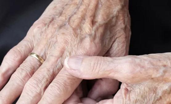 老年斑并不是老年人的專利 預防和延緩老年斑發生的食物