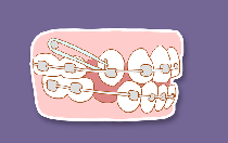 曝光武漢德韓口腔：成年人牙齒矯正的效果怎么樣？