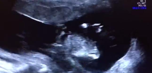 天津天孕醫院做四維怎么樣 看雙胞胎孕媽如何說